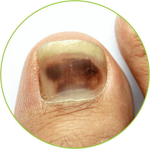 toenail fungus can cause the toenail to separate from the toenail bed.