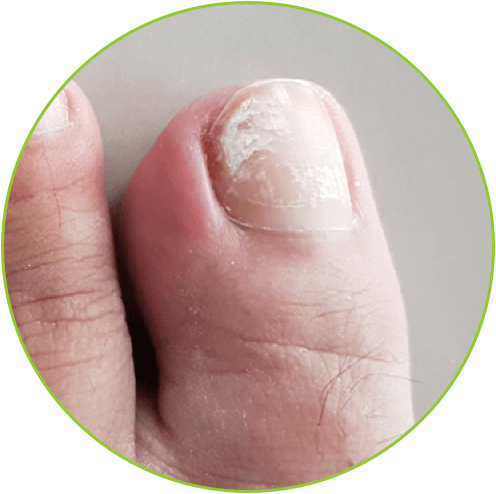 toenail fungus can cause the toenail to separate from the toenail bed.