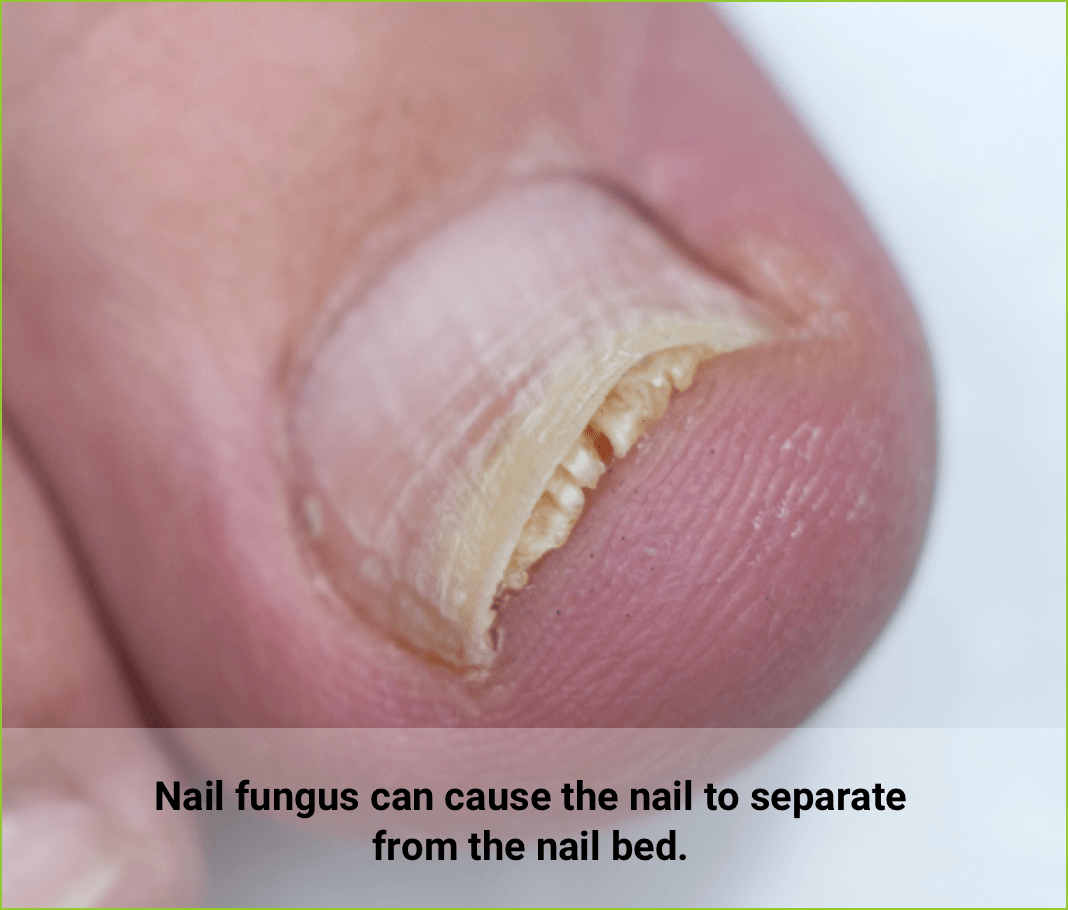 Nail fungus can cause the toenail to separate from the toenail bed.