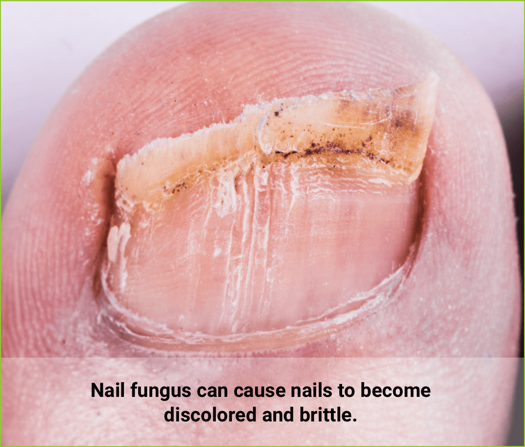Nail fungus can cause nails to become discolored and brittle.