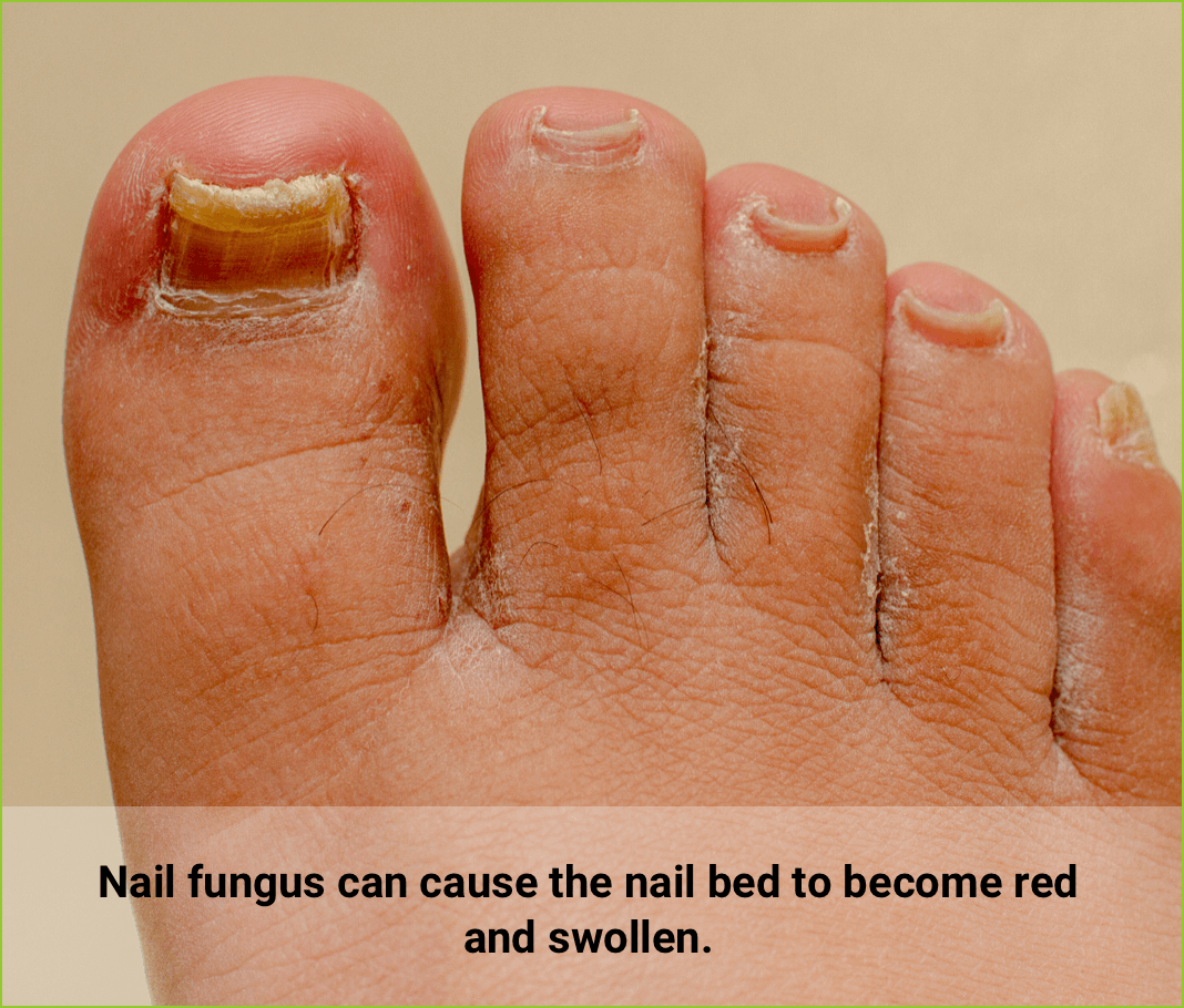 Nail fungus can cause the toenail bed to become red and swollen.